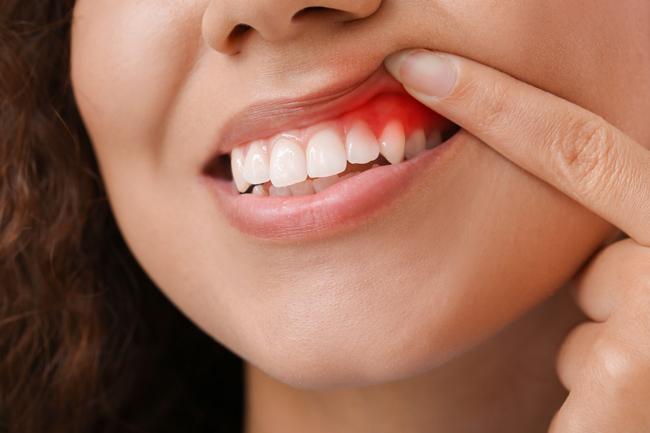 මුඛ පිළිකාවලින් ලංකාවේ දිනකට පුද්ගල මරණ 3ක්